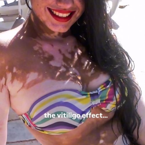 Vitiligo, transformação visual e comentários que passaram do limite